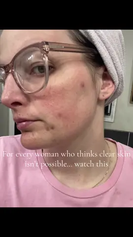 I remember when my face started breaking out I thought this was never going to end. I cried constantly and never wanted to leave the house. I didn’t understand why I was getting these huge cystic pimples all over my face. I cut back on sugars and they kept coming.  I cut back on alcohol and they kept coming.   I upped my water intake and they kept coming. It wasn’t until I started ingesting and applying Hydroxytyrosol faithfully on my face and in my body that my skin started to finally see the light at the end of the tunnel. Check my profile for my acne must haves or comment ACNE for the link.  The products last 4-7 months, are holistic & bioactive, & there’s a 365 day guarantee return policy. You’ll get your 5th product free too 💕