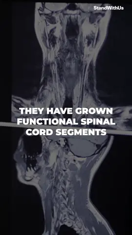Israeli innovation at its finest: Scientists in Israel developed the world’s first lab-grown spinal cord which will be implanted in 8 patients. A life altering medical breakthrough that could help paralyzed patients regain mobility. 🇮🇱🩺