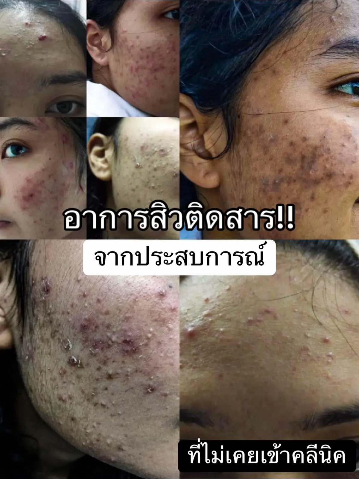 #สิวติดสาร #สิว #สิวอักเสบ 