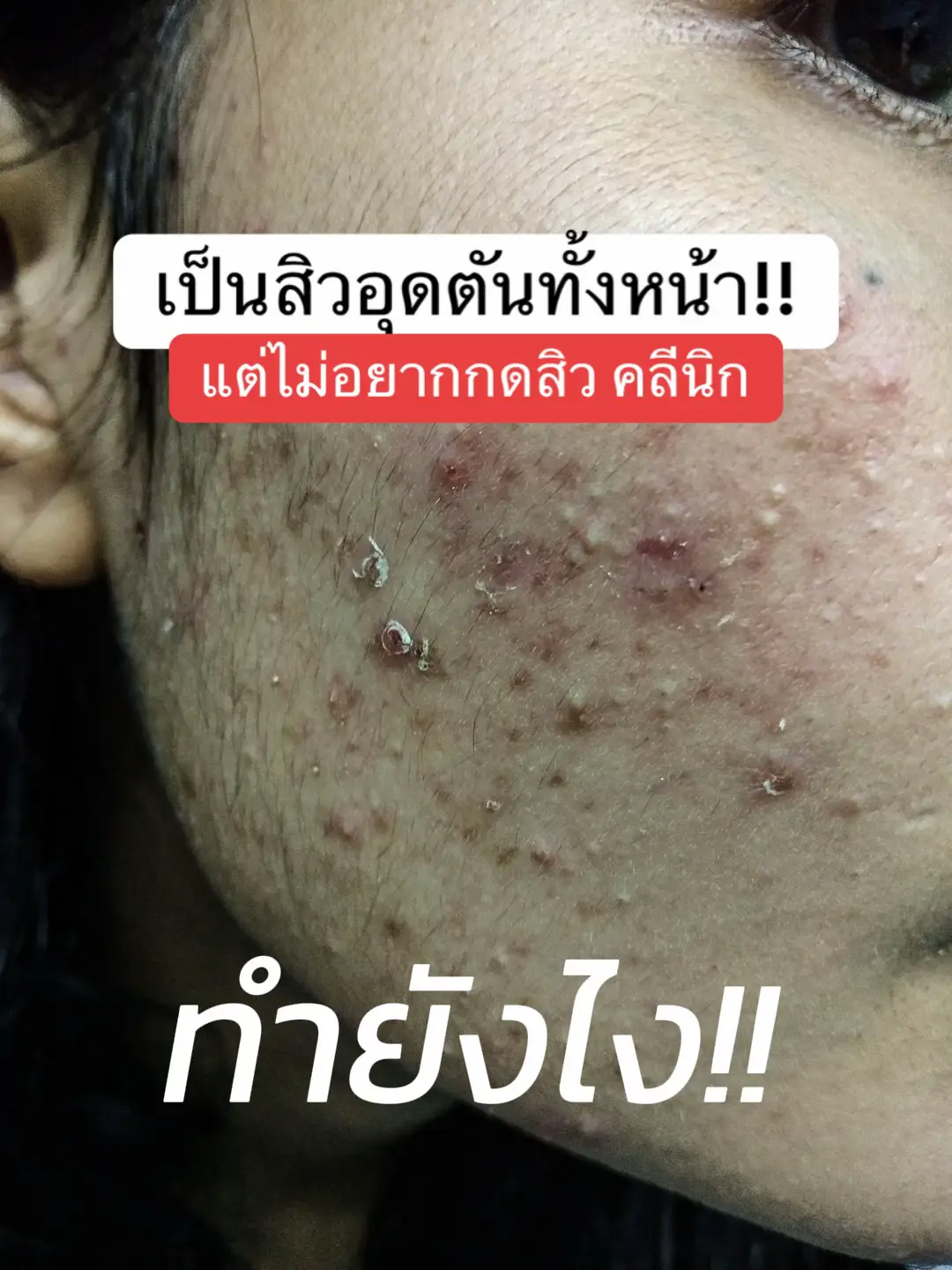 เชือกคลีนซิ่งให้ดีๆน้า สำคัญมากๆ #สิวติดสาร #สิว #สิวอุดตัน #แพรวแชร์ทริค 