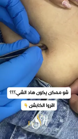⁨	كتير من الصبايا بيحلقو شعر البطن بس ما الكل بينتبه انو بفوت قسم من الشعر على السرة مع الوقت بيتراكم الشعر و فوقو الجلد الميت و الكيراتين ليشكل حجر السرة أو التكتلات السرية ‏Omphalolith or umbilical concretion حالة نادرة و حميدة و الأفضل تزال بيد الطبيب مشان ما تلتهب السرة لذلك كتير مهم تنظيف المنطقة خاصة بعد الحلاقة و بشكل عام خلال الاستحمام. . . . . . . #explore  #dubai 