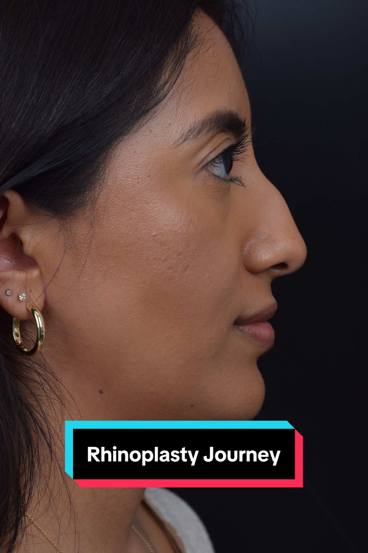 EARLY POSTOP #rhinoplasty. I often see people that have disproportion on their front view. When patients have a localized hump, it often creates narrowing of the bridge and sharpness of the nasal bone in that area. In this patient, I modified the bony surface and sculpted the cartilage. This is all that was necessary to remove the hump and to gain width. The bridge was then lowered as a unit so that I could optimize the profile. This patient is only 1 month out from #rhinoplastysurgery, but her nose already looks much more balanced. Her profile looks stunning, and the front view will continue to refine over time. These cases can be difficult because the skin is thin at the top and thick at the bottom. Different treatment modalities are necessary to obtain optimal results. #nosejob #piezosurgery 