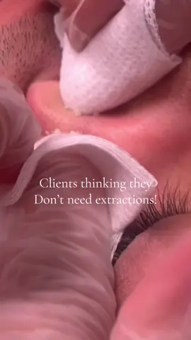 Satisfying!!! #satisfying #facialtreatment #creatorsearchinsights  #fypシ #blackhead 