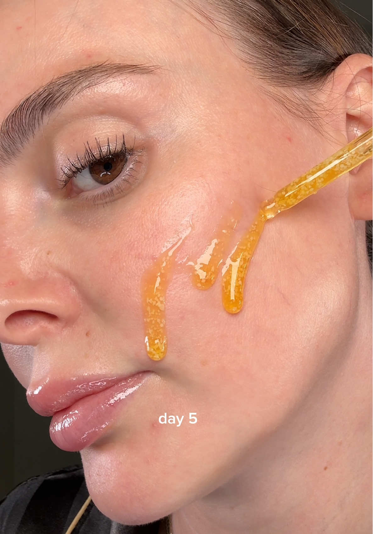 Fading acne scars and dark spots with the Vitamin Illuminating Serum @EQQUALBERRY 🧡🍊   #eqqualberry #vitamincserum #darkspot #acnescar #hyperpigmentation  