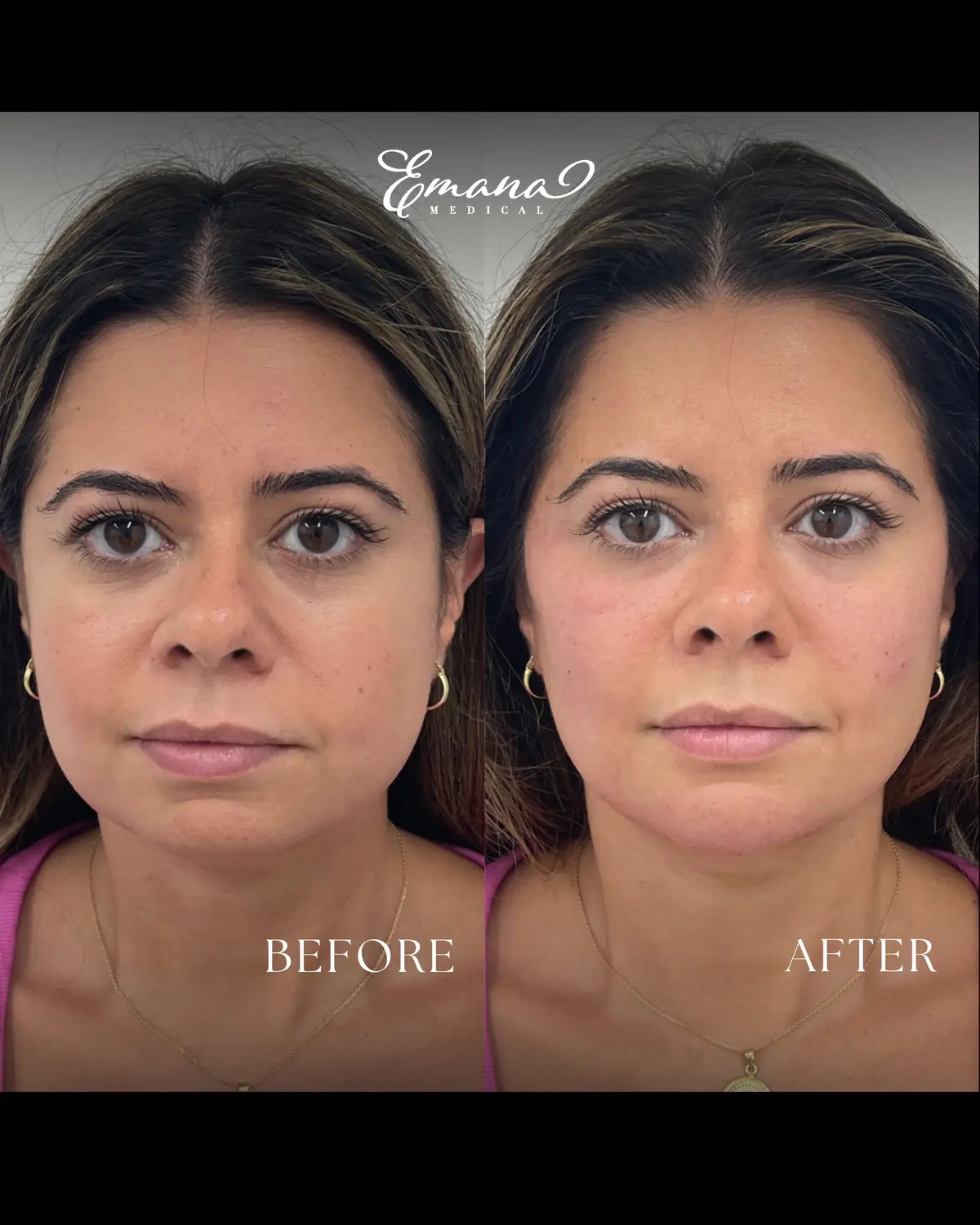Aging gracefully? Yes. But dull, saggy skin? No thanks. Our goal isn’t to “change” your face - it’s about looking natural, lifted, and refreshed... Every procedure is personalized to fit the client’s desired outcome, while always prioritizing safety and natural-looking results. At Emana Medical, we make subtle look stunning.  💸 Finance your treatments with Cherry! @withcherryus 🍒 Apply in seconds 🍒 Immediate funding 🍒 0% APR plans available 🍒 No hard credit check 🍒 High patient approval rate FOR BOOKINGS 📲 (310) 878-4321 📩 DM @dremanabdallah 📍 Beverly Hills 