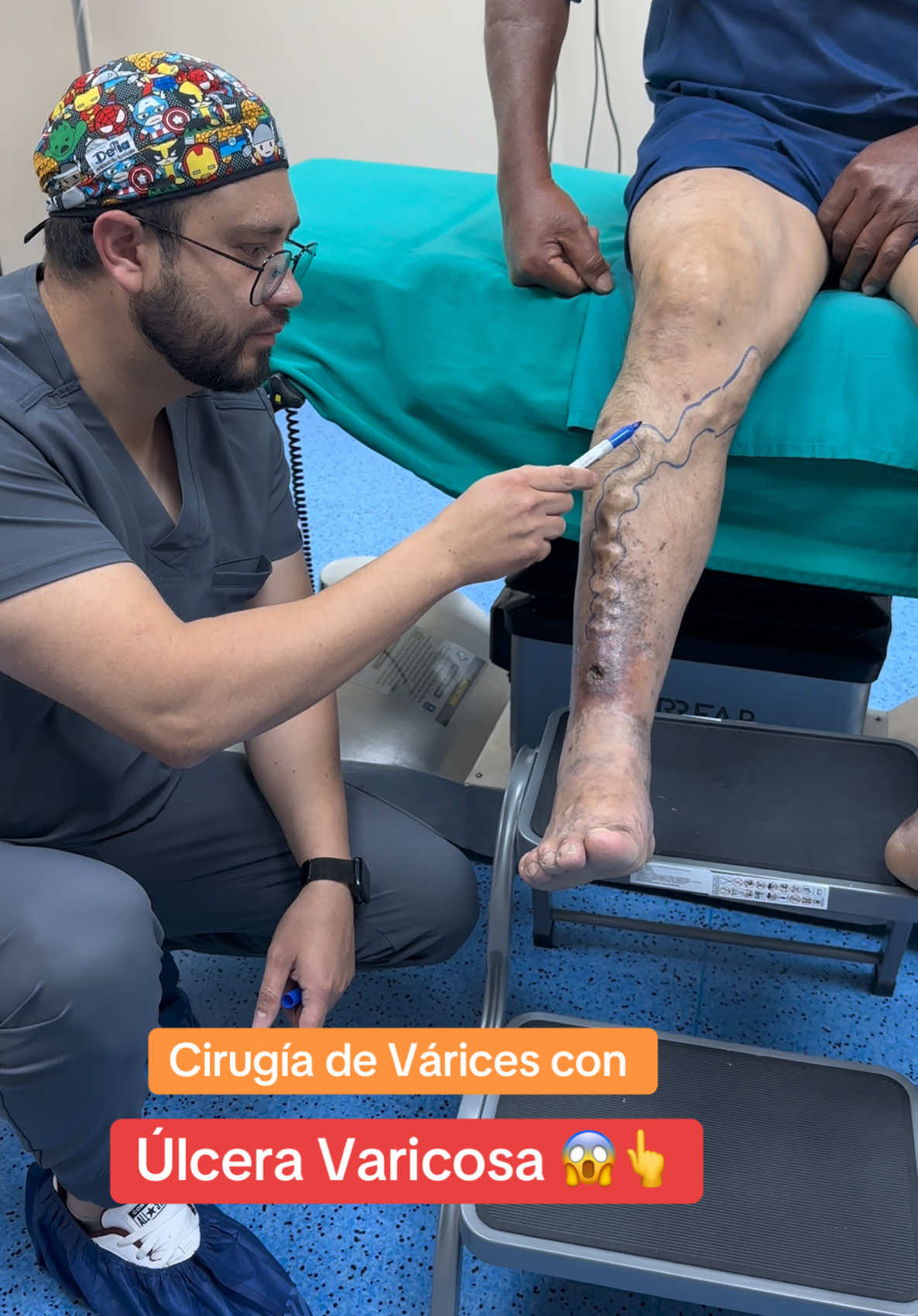 🏩 La Úlcera Varicosa 😱👆 es una seria complicación de no tratar tus Várices a tiempo 🥲 lleva a dolor , infección, y muchas molestias además de una pésima calidad de vida @The Vein Doctor 👨‍⚕️ 👉 Riovasc 👈📲+593995178395/+593958757917 #ulceravaricosa #varices #varicesenlaspiernas #venasvarices #varicesyarañitas #arañasvasculares #paratiiiiiiiiiiiiiiiiiiiiiiiiiiiiiii #cristianbravo148 #cirugiavascular 