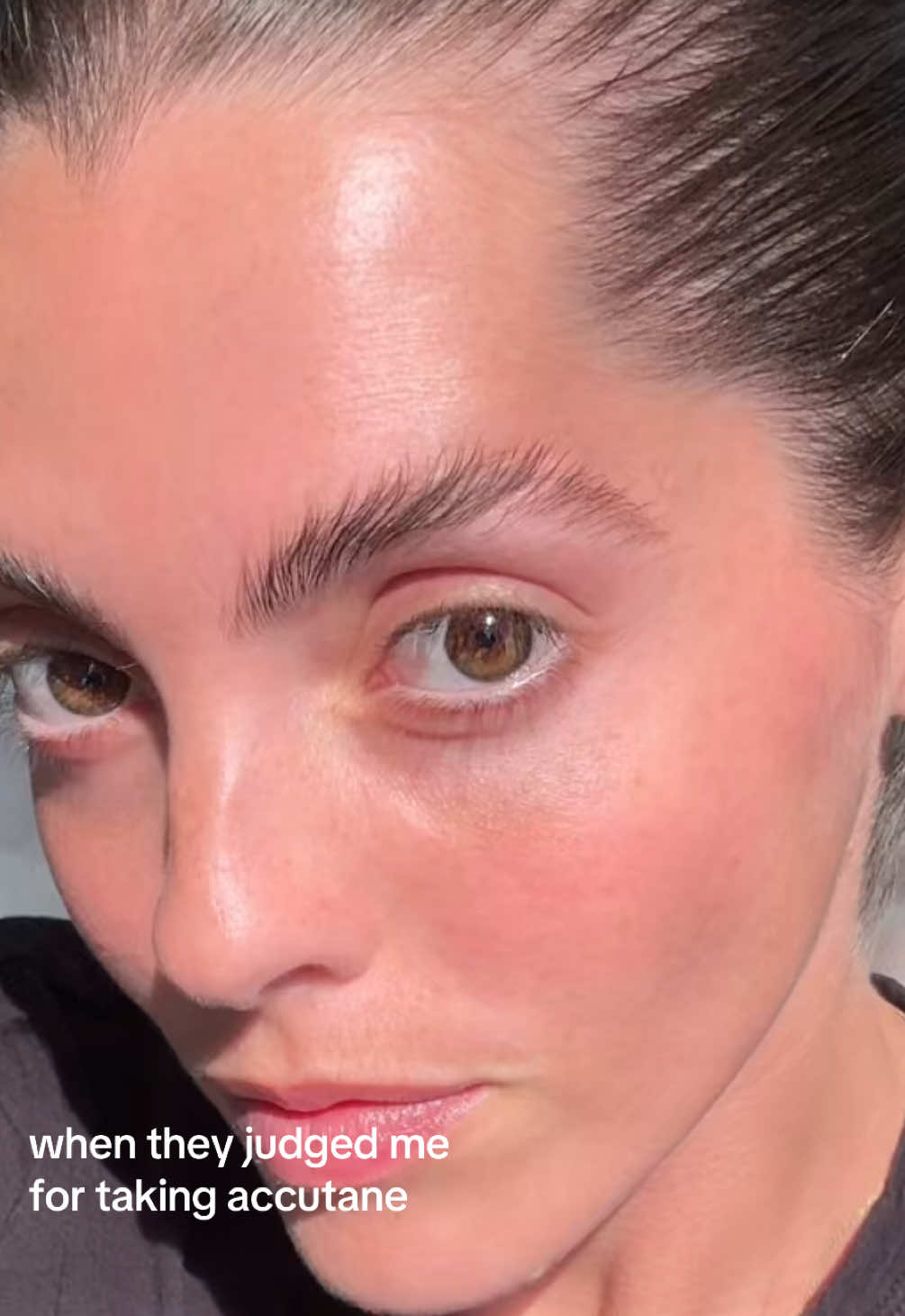 Hear me out — accutane was never my first choice or the end goal. BUT… it ended up being the best decision that I made for myself. Here’s your reminder that acne healing is not once size fits all!!! What might be the best decision for me, might not be for the person next to me ❤️‍🩹😶‍🌫️🫧#accutane #accutanecheck #acnesafe #acnetreatment #judgementfreezone 