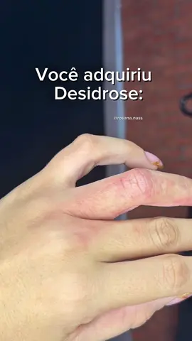Pequenas bolhas nas mãos e/ou pés acompanhadas de coceira e descamação. A causa exata da desidrose não é totalmente conhecida, mas está ligada a fator emocional como estresse e ansiedade, suor excessivo e sensibilidade. 😮  #desidrose #desidroseansiedade #desidroseemocional 
