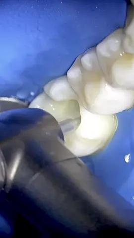 Este caso me gustó mucho. Paciente con sobrecarga funcional, mordida abierta anterior, molares con tratamiento endodóntico y con paredes proximales ausentes. 