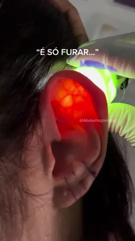 Nossas orelhas têm vários vasinhos de sangue: alguns bem finos (capilares) e outros mais grossos, que irrigam a pele e o pericôndrio (a camada que nutre a cartilagem). 👉 Se um vaso desses se rompe podem acontecer algumas coisas: 	•Sangramento excessivo; 	•Hematoma (acúmulo de sangue entre a pele e a cartilagem): a orelha pode inchar, ficar roxa e dolorida. Esse é o risco mais comum. 	•Se não tratado, o hematoma pode levar a uma complicação chamada “orelha em couve-flor” (a cartilagem deforma por falta de nutrição, porque o sangue acumulado impede a circulação normal). 	•Infecção: o sangue acumulado pode servir de meio para bactérias, aumentando o risco de inflamar. Procure um profissional que te dê um atendimento completo e responsável! ♥️