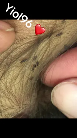 Remove lice #omg🙀🙀😱😱❤️❤️🙏 #lice #liceremoval 