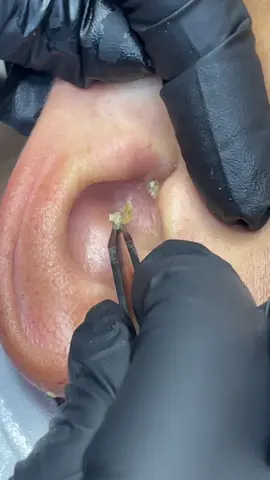 this is a blackhead I partially extracted a few months ago that filled back up-best extraction of my career tbh 🤤  #extractions #blackhead #facial #esthetician #stlouis 