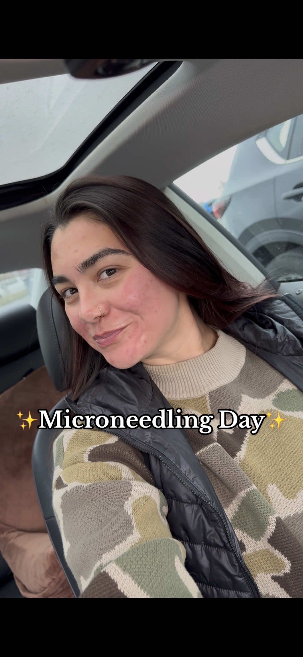The results from immediately after are at the end✨ I’ve had an acne flare up this past year and wanna clear any scarring up! #Skincare #microneedling #microneedlingtherapy #acnescars #acne 