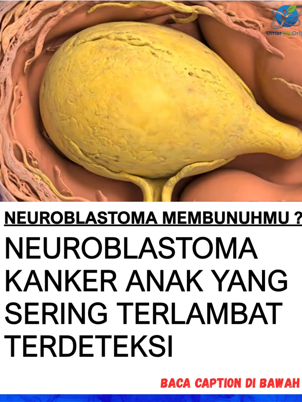 Apa Itu Neuroblastoma? Kanker ganas yang berasal dari sel saraf primitif (neuroblast) di sistem saraf simpatis, biasanya muncul di kelenjar adrenal (atas ginjal). Paling sering menyerang bayi & anak <5 tahun. ⚠️ Faktor Risiko: Usia balita (terutama <2 tahun) Faktor genetik tertentu (riwayat keluarga jarang tapi ada) Mutasi gen bawaan sejak lahir 🔍 Gejala yang Perlu Diwaspadai: Benjolan di perut (keras, tidak nyeri) Perut membesar Penurunan berat badan Anak lemas, pucat (anemia) Nyeri tulang (kalau sudah menyebar) Mata panda (lingkaran hitam sekitar mata, bisa ada perdarahan) Kesulitan bernapas / tekanan dada (kalau tumor di mediastinum) 📉 Tahapan Perkembangan: 1️⃣ Tumor terbatas di adrenal/perut → benjolan keras 2️⃣ Menekan organ sekitar → perut buncit, gangguan makan 3️⃣ Menyebar ke kelenjar getah bening/tulang → nyeri tulang, pucat, lemas 4️⃣ Stadium lanjut → menyebar ke hati, sumsum tulang, kulit 💉 Terapi Umum & Pendukung: Operasi (angkat tumor bila masih lokal) Kemoterapi (stadium lanjut) Radioterapi (terpilih) Dukungan terapi untuk daya tahan tubuh & kualitas hidup anak 🛡 Kenapa Neuroblastoma Berbahaya? ✔️ Sering tidak terdeteksi sampai stadium lanjut ✔️ Bisa tumbuh cepat & menyebar ke tulang/sumsum tulang ✔️ Gejala mirip “sakit biasa” (perut buncit, lemas) → bikin orang tua telat curiga 📞 Butuh Konsultasi Lebih Lanjut? 👉 Hubungi: 0855-9118-6101 🔖 Hashtag Edukasi: #Neuroblastoma #KankerAnak #DeteksiDini #KesehatanAnak #EdukasiKesehatan