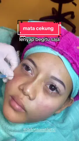 filler under eye