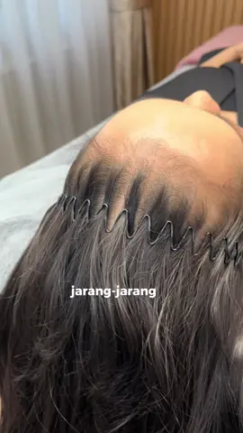 FOLLOW buat liat hasil akhirnya! 🥰✨ Client kita kali ini mengalami receding hairline - atau hairline yang mundur banget, ini bisa bikin gak pede ya kalau iket rambut. Tapi dengan Scalp Micropigmentation rambut bakal keliatan auto tebal hanya dalam 2 jam aja ✅ Minimal Pain  ✅ No down time  ✅ Instant result Keliatannya sepele, tapi ini bener2 bisa ngubah look serta confidence kamu loh!  Buat kamu yang mau KONSUL GRATIS, book sesi kamu via WA 085137045437 yah! #sulamrambut #scalpmicropigmentation #sulamrambutjakarta #sulamrambutindonesia #sulamrambutjkt 