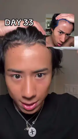 DAY 33 of using body wise hair growth serum #balding #hairgrowth #hair #haircare 