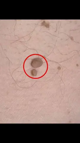 #sante #parasite #parasites #micoparasites 