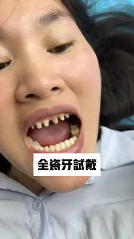 #微笑牙 #牙齒 #牙貼片 ##微笑牙 #牙齒 #牙貼片 #全瓷牙 #牙齒美白 #牙齒矯正 #全瓷貼片 #全瓷冠#種植牙  