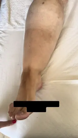 🦶Il segno del calzino, nel lipedema, è una brusca interruzione del tessuto adiposo a livello della caviglia.  Come mostrato dal video, la paziente con Lipedema di III tipo, non presenta a livello della caviglia una continuità del tessuto adiposo, ma una interruzione, infatti i piedi non sono coinvolti (apparentemente).  ⚠️Il segno del calzino nel lipedema, NON È il segno che lascia sulla pelle l’elastico del calzino! ✔️Seguimi per continuare a conoscere la patologia del lipedema!   #lipedemafisioterapia #perteeee #fypシ゚ #viralditiktok #viralvideo🔥 