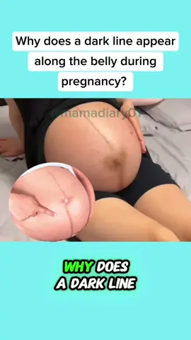 Why does a dark line appear along the belly during pregnancy? #tipsparenting #pregnant #parenting #babytiktok #baby #newborn #tipsbaby 