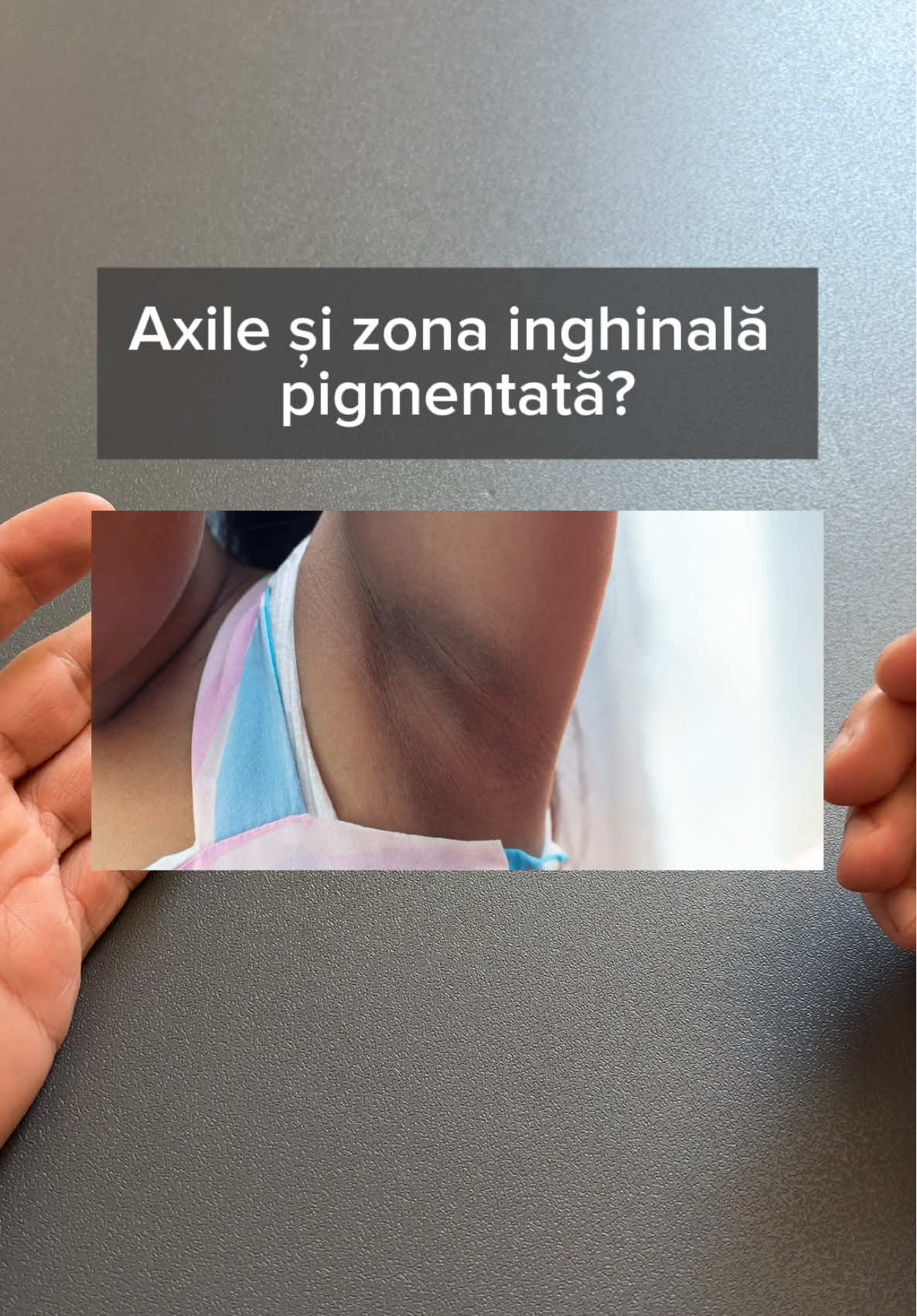 #hiperpigmentare #axile #exfoliere #skincare #skincarepebune 