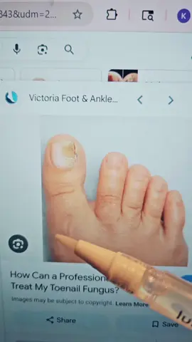 Antifungal pen