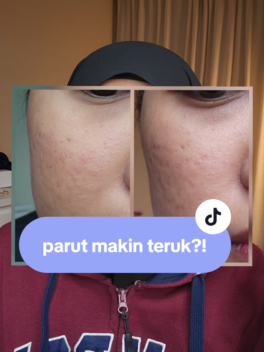 klinik kulit jb yang nak collab boleh roger roger 😆  #klinikkulitjb #weightloss #parutjerawat #diet #turunberatbadan 