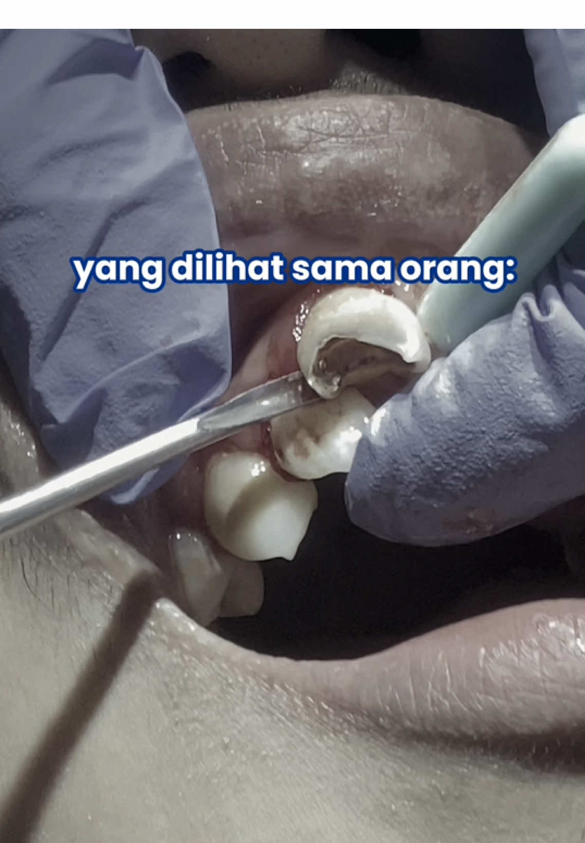 😱 Banyak orang langsung merinding kalau dengar kata cabut gigi. Padahal, cabut gigi nggak seserem yang dibayangin loh! ✨ Dengan teknologi yang makin canggih dan dokter yang telaten, proses cabut gigi sekarang jauh lebih nyaman: 🦷 Pakai bius lokal jadi minim rasa sakit 🤝 Proses cepat & aman 👩‍⚕️ Dokter jelasin langkahnya dengan detail biar kamu tenang 😊 Hasilnya? Rasa sakit hilang, senyum pun lega! Jadi, jangan takut duluan ya. Kadang cabut gigi memang jadi solusi terbaik untuk kesehatan gigimu. Kalau kamu masih ragu, yuk konsultasi dulu sama dokter gigi terpercaya 👇 📍 Sini Dental Studio – Jl. Raya Cinunuk No.200 📲 Klik link di bio atau DM untuk reservasi #SiniDentalStudio #KlinikGigiBandung #CabutGigi #KlinikGigiCinunuk #DokterGigiBandung          