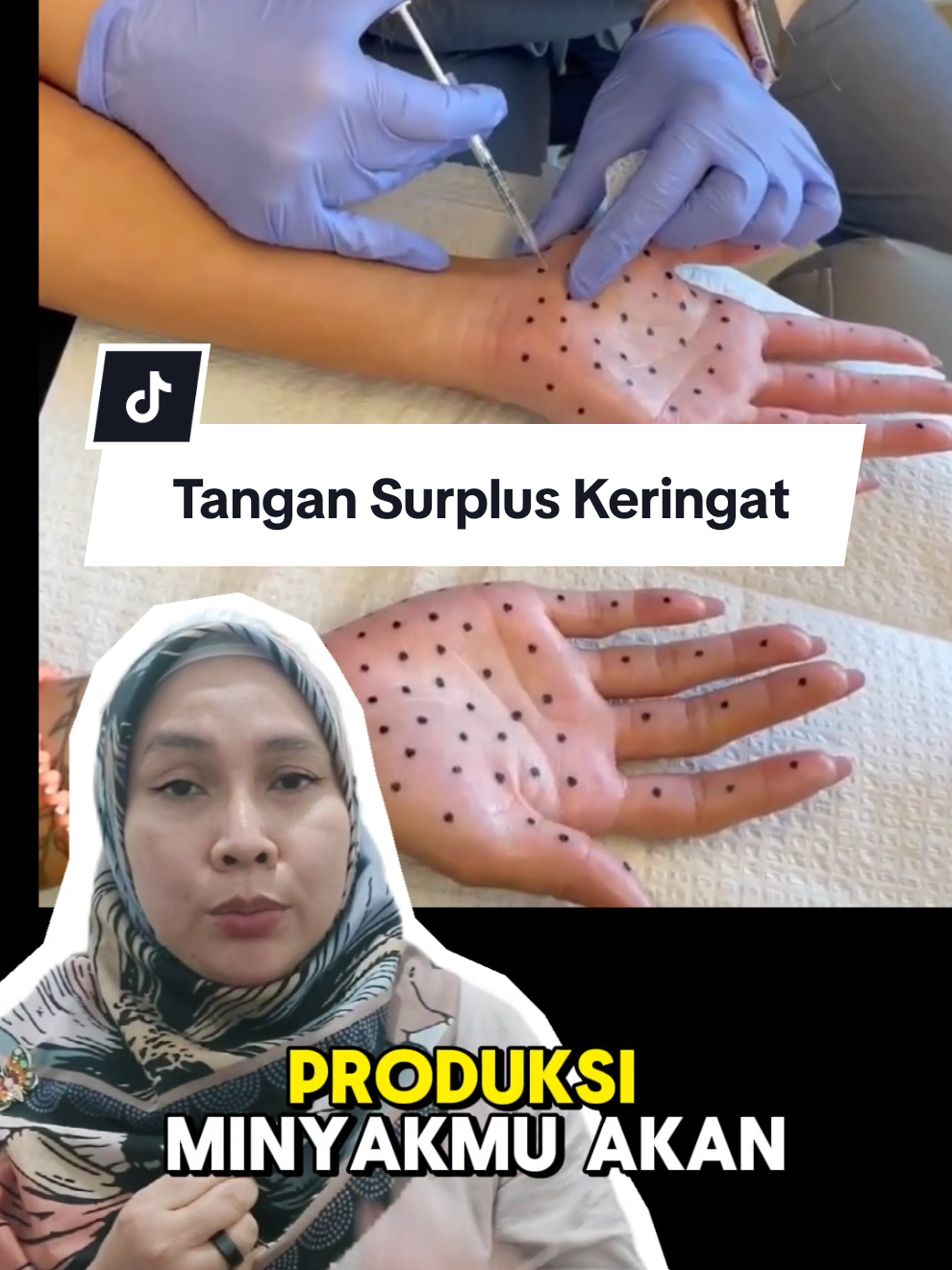 Replying to @agawbw ini penanganannya #botox #hiperhidrosis #dokterkecantikan #dokterestetika #tanganberkeringat 