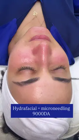 Hydafacial X Microneedling  #fyp #beauty #algeria #glow #skincare 