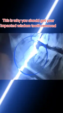 This is why you should get your impacted wisdom tooth removed  🦷✨ #extractionvideo #100k #foryou #views #foryoupageofficiall  @Dr. Faiqua Anwar 