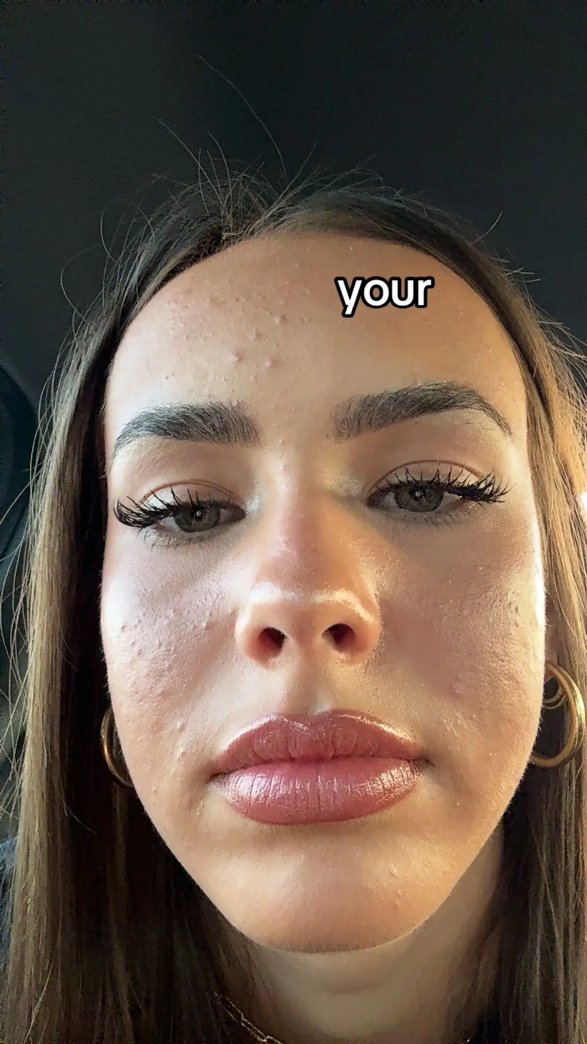 i’ve had it for 3 years now and i just want u to know you’re not alone #acne #fypシ #acneproneskin 