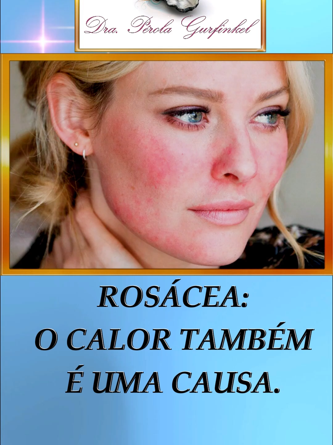 🥵 ROSACEA: O CALOR TAMBÉM É UMA CAUSA. 🔥  É caracterizada por rubor, sensação de quentura no rosto, pápulas, pústulas, chegando até ao alargamento do nariz, chamado de rinofima, que é o último grau. Sem tratamento, a rosácea se torna crônica ao ponto de chegar no rinofima. O tratamento consiste de um conjunto de procedimentos, que englobam laser específico para rosácea e fórmulas personalizadas manipuladas e individualizados para cada grau da rosácea. Rosácea: ela progride a um estágio bem ruim. Mas tem tratamento eficaz. Marque sua Consulta e Sinta-se Cada Vez Melhor. DRA. PÉROLA GURFINKEL ☎ (11) 2359-5971 ☎ (11) 98432-8018. #dermatologiasp #laser #cuidadoscomapele #vilaolimpia #rosacea #saúde #beleza #medicina #saúde #cuidados #fit #fitness #academia #verão #rosacea