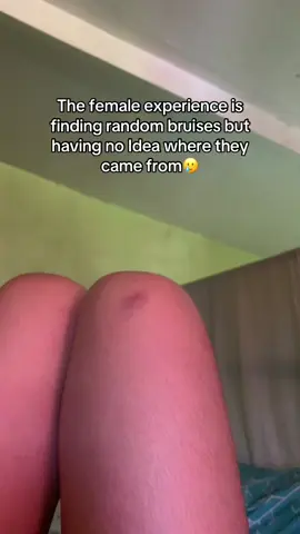 Little miss mysterious bruises HAHAHAHAAHHAAHHAHAHA😭😭😭 Why do girls always have random bruises with unknown origins??? #bruises #mysteriousbruises 