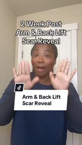 Finally getting to see my scars 2 weeks post arm and back lift so let’s do a scar reveal  #looseskinremoval #armlift #backlift #looseskin #scarreveal 