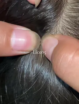😱😱😱#omg #lice #liceremoval 