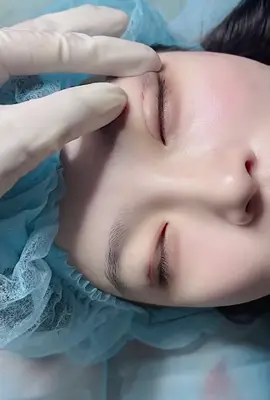 Không lo sẹo xấu. Ko ăn kiên ✅ #nhanmi #xuhuong #thinhhanh #lamdep #viral 