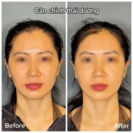 Khách hàng luyện tập thể thao cường độ mạnh, é.p câ.n dẫn đến việc thái dương bị hóp rất nhiều mà ko thể đầy lại kịp với lịch thi đấu. Và giải pháp của EM dành cho bạn là t.iê.m filler thái dương, giúp làm đầy thể tích ngay, kịp thời với lịch trình của bạn, không cần nghỉ dưỡng, ko mất thời gian đợi tăng sinh lại. #emdebeaute #filler #botox  _______________ 𝗘𝗺 𝗱𝗲 𝗕𝗲𝗮𝘂𝘁𝗲́ 𝐵𝑟𝑖𝑛𝑔 𝑦𝑜𝑢𝑡ℎ 𝑏𝑎𝑐𝑘 Tại Em, chúng mình luôn tôn trọng đường nét sẵn có của bạn và điều chỉnh để khuôn mặt hài hoà, nhiều sức hút hơn! 📩 I.n.b.o.x để được tư vấn chi tiết về dịch vụ nhé