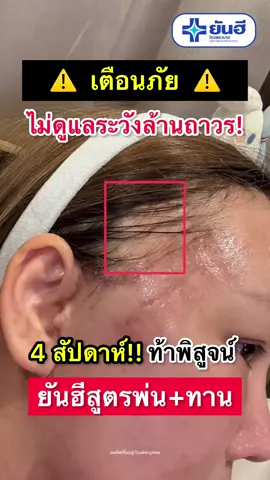 เตือนภัย⚠️ ระวังล้านถาวร #ผมร่วง #หัวล้าน #ยันฮีไบโอตินพลัส #ยันฮีทีเซอร์ #ps654 