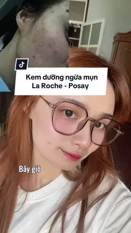 Bà nào đang bị mụn tuổi dậy thì, mụn nổi tiết hay mụn do bị kích ứng, thì thử liền em nó cho tôi #songngureview #LRPVN #larocheposayvn #franchise #effaclar #skincare #chamsocda #reviewlamdep 