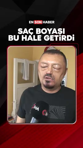 Adana'da saçlarını beyazlardan kurtarmak isteyen vatandaşın internetten aldığı saç siyahlaştırıcı şampuan hastanelik etti. #saç #boya #adana #internet