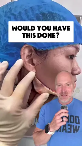 Do you think there is a limit to what is ok when it comes to elective aesthetic plastic surgery? … Is any elective procedure ok? … How do you define what is ok to do to your body? … Comment below 👇🏻👇🏻👇🏻 … #toomuch #plasticsurgery #aesthetics #aesthetic 