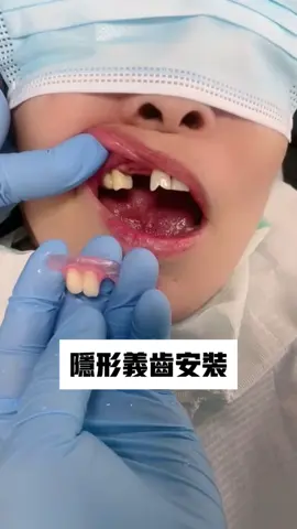#微笑牙 #牙齒 #牙貼片 ##微笑牙 #牙齒 #牙貼片 #全瓷牙 #牙齒美白 #牙齒矯正 #全瓷貼片 #全瓷冠#種植牙   