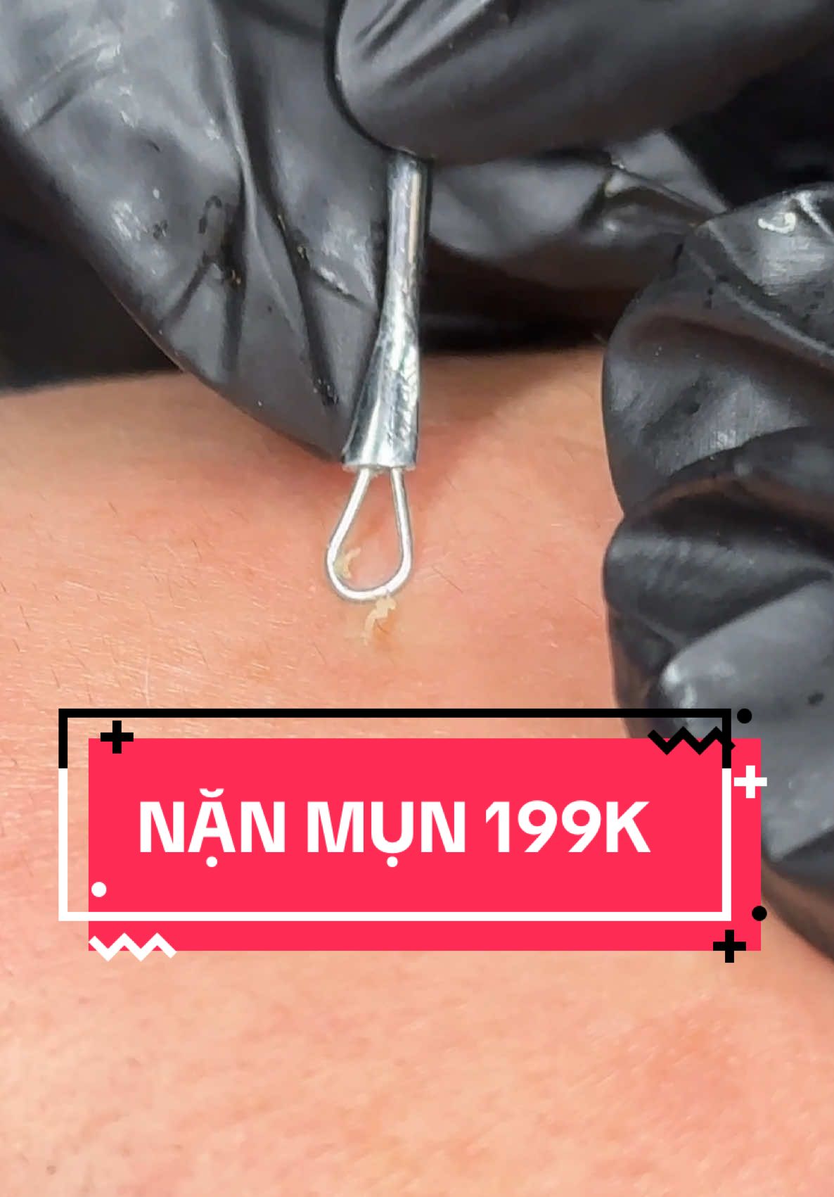 NẶN MỤN CHUẨN Y KHOA – CHỈ 199K 🔥 📹 Video thực tế tại TSS Glow-Lab – nơi khách hàng được chăm sóc từng bước, dụng cụ vô trùng riêng biệt, thao tác kỹ – sạch – không bỏ sót. 💆‍♀️ Da được làm sạch sâu, loại bỏ mụn cám, mụn ẩn, trả lại làn da thông thoáng mịn màng. 🌸 Chỉ với 199K, bạn đã được trải nghiệm dịch vụ chuyên nghiệp, không lo đau, không lo lây nhiễm. 📩 Số lượng suất ưu đãi có hạn – inbox ngay để giữ lịch, vì lịch spa đang kín dần rồi đó! #spa #viral #fyp #hếtmun 