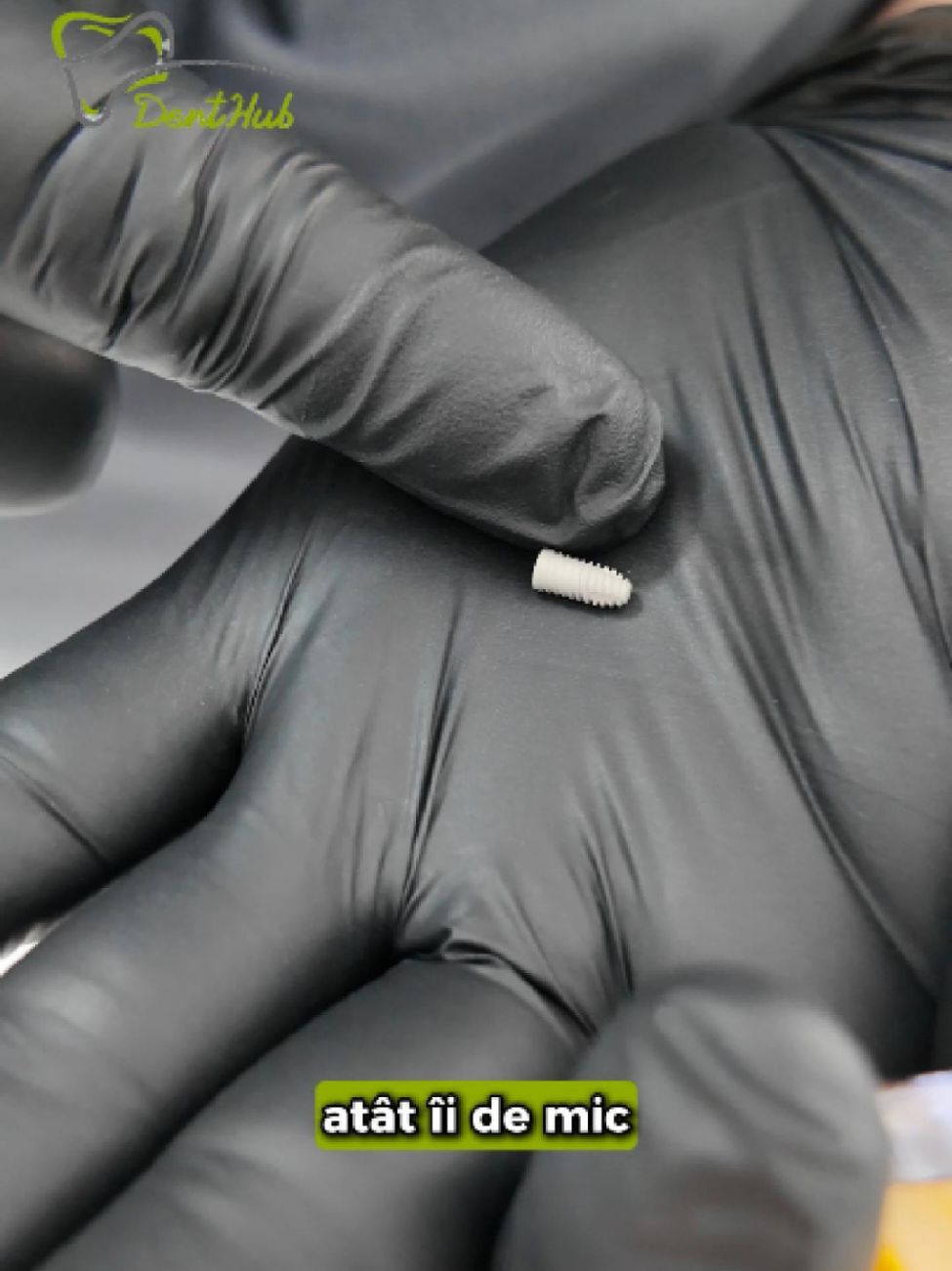 🦷 Ce este, de fapt, un implant dentar? Mulți pacienți se tem de cuvântul „implant”, dar în realitate vorbim despre o piesă foarte mică, cu beneficii uriașe: ✨ aspect natural și estetic ✨ funcționalitate completă ✨ stabilitate pe termen lung ✨ durată de viață mare La DentHub, le arătăm pacienților noștri că implantul nu este un motiv de frică, ci soluția prin care îți poți recăpăta zâmbetul și încrederea. 💙 👉 Vino și tu să faci parte din familia DentHub – te așteptăm cu drag să îți redăm bucuria de a zâmbi! 📍 Strada Revoluției, nr. 168, Oțelu Roșu 📞 WhatsApp & Telefon: +40 773 840 455 🌐 dent-hub.eu #DentHub #ImplanturiDentare #FărăDurere #ZâmbetNou #Încredere 