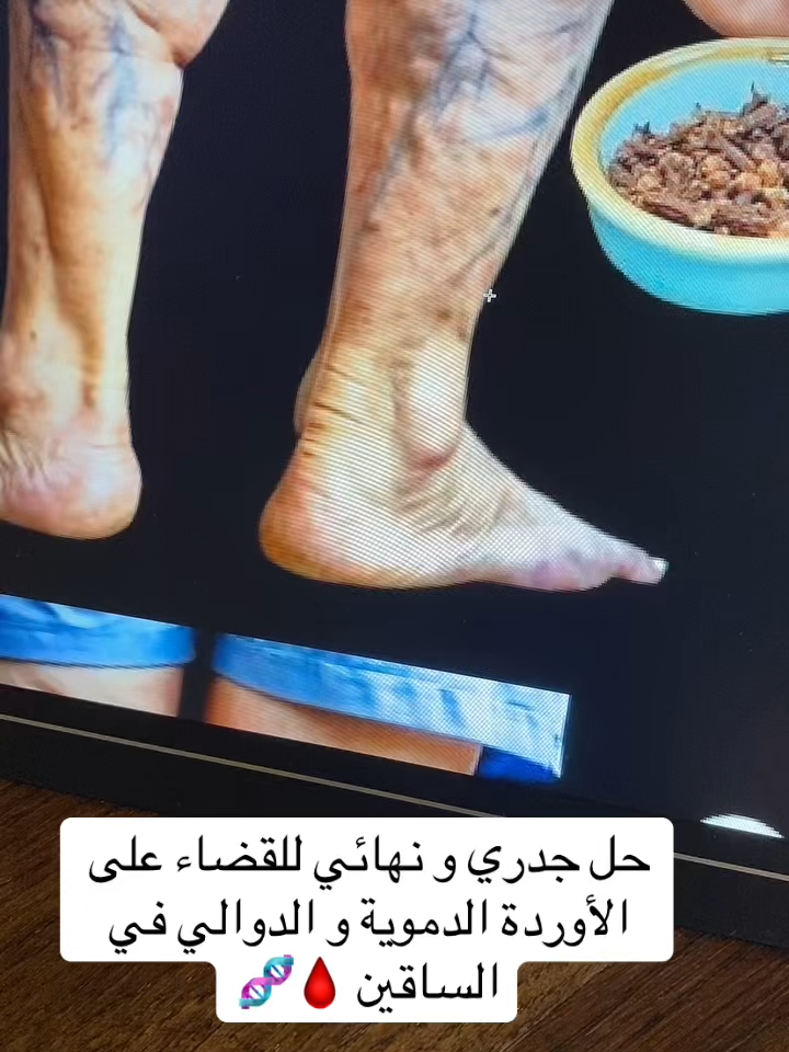#دوالي_الخصيه #تيك_توك_عرب #الدوالي #الدوالي_الوريديه_أسبابها_وأعراضها #الدوالي_العنكبوتيه #استشارات_طبية #معلومات_طبية #الدمام_الخبر_الشرقيه #الرياض_الان #الدوالي_الدوالي #مكة_المكرمة #saudiarabia🇸🇦 #اكسبلور #الطائف_الان #دكتوره_رحمه_الغيلي #رحمة_الغيلي