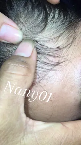 Oh my god, I have to deal with this.#omg😘😘🥳🥳😭😭🤪🤪🤮🤮 #loveremoval #lice 