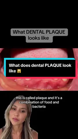 Do you know the difference between plaque and tartar? #bracestips #braceson #oralhealth #oralhygienetips #ConSantanderConecto 