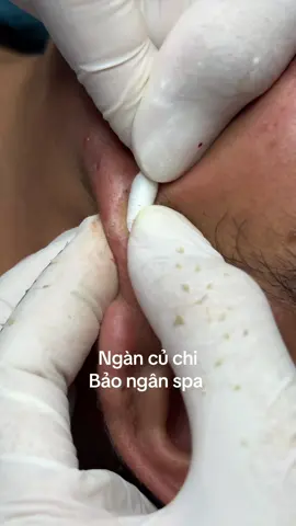 Xử lý dc sạch dạng mụn như này thì Học viên ra nghề dc rồi #baonganspa #storecuchi8688 #ngancuchi #daotaohocvien #mụn 